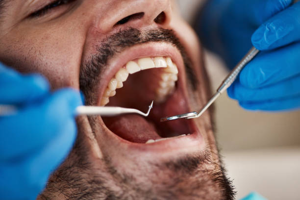 Best Emergency Wisdom Tooth Extraction in Indian Hills, TX